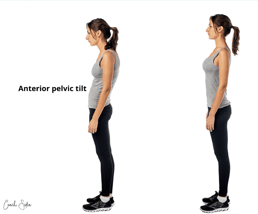 anterior pelvic tilt weak gluteus maximus