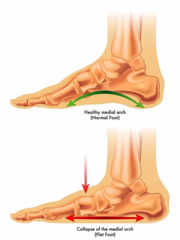 flat foot vs arch