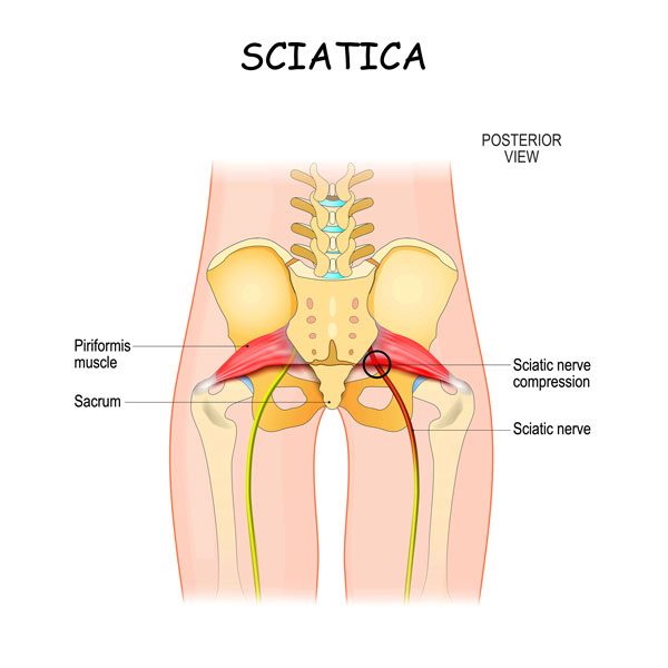 How To Treat Sciatic Nerve Pain At Home, by Sofia, Dec, 2023