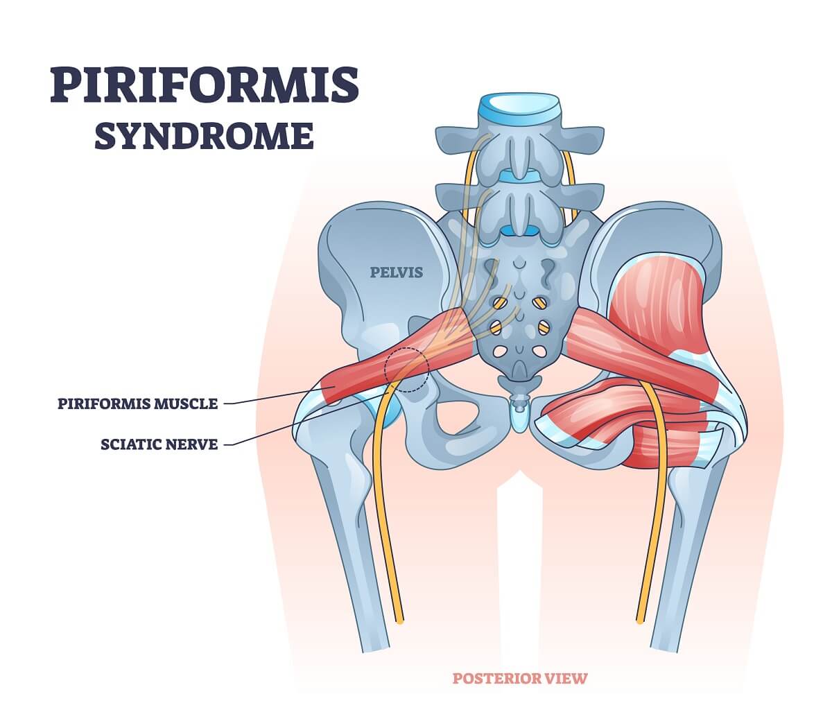 Piriformis Syndrome Explained